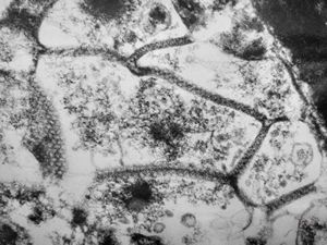 M,51y. | septate junctions between giant multivesicular bodies - lung, necrotizing pneumonia M,51y. | septate junctions between giant multivesicular bodies - lung, necrotizing pneumonia